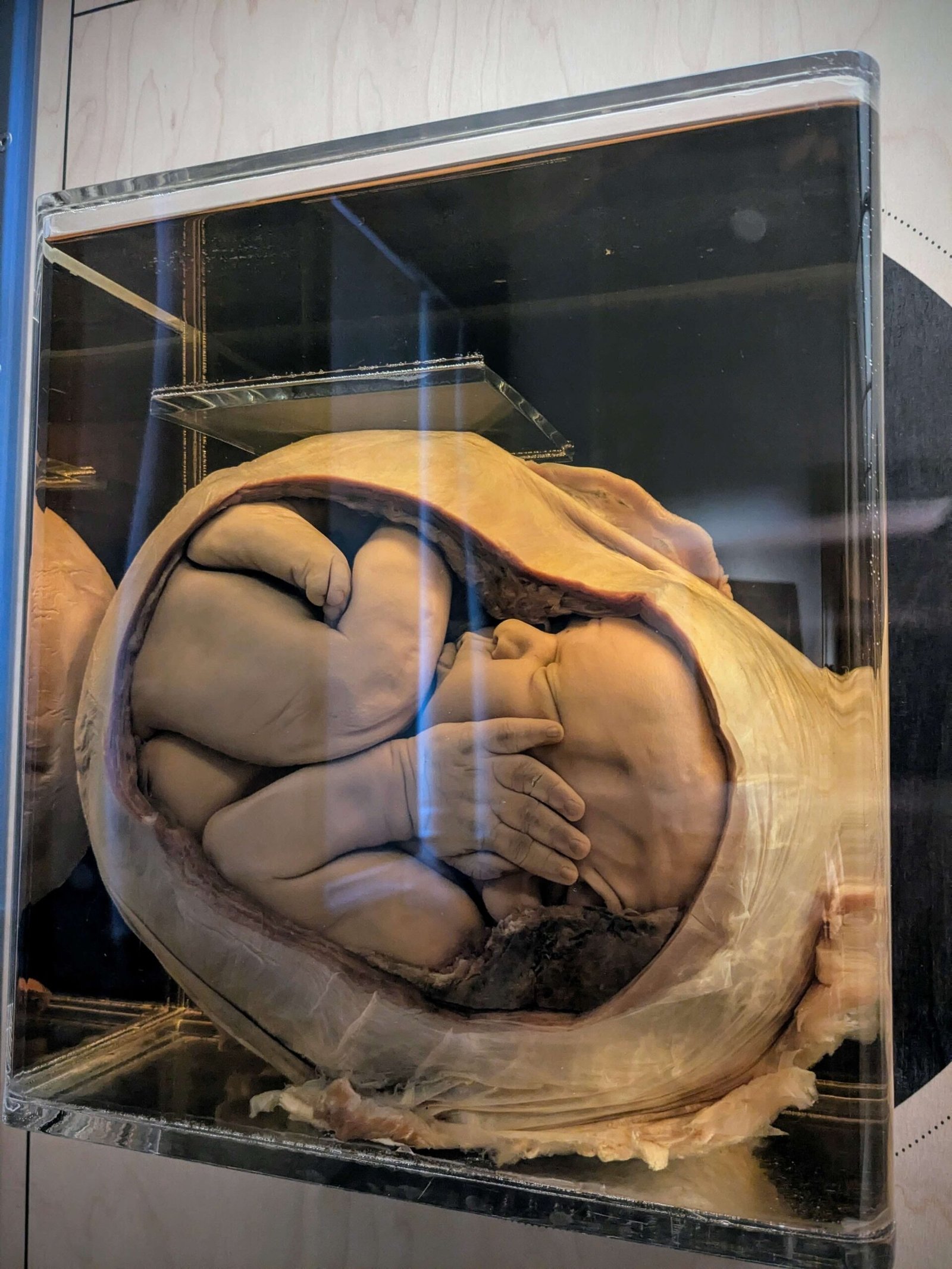 a malformed foetus at the medical museum